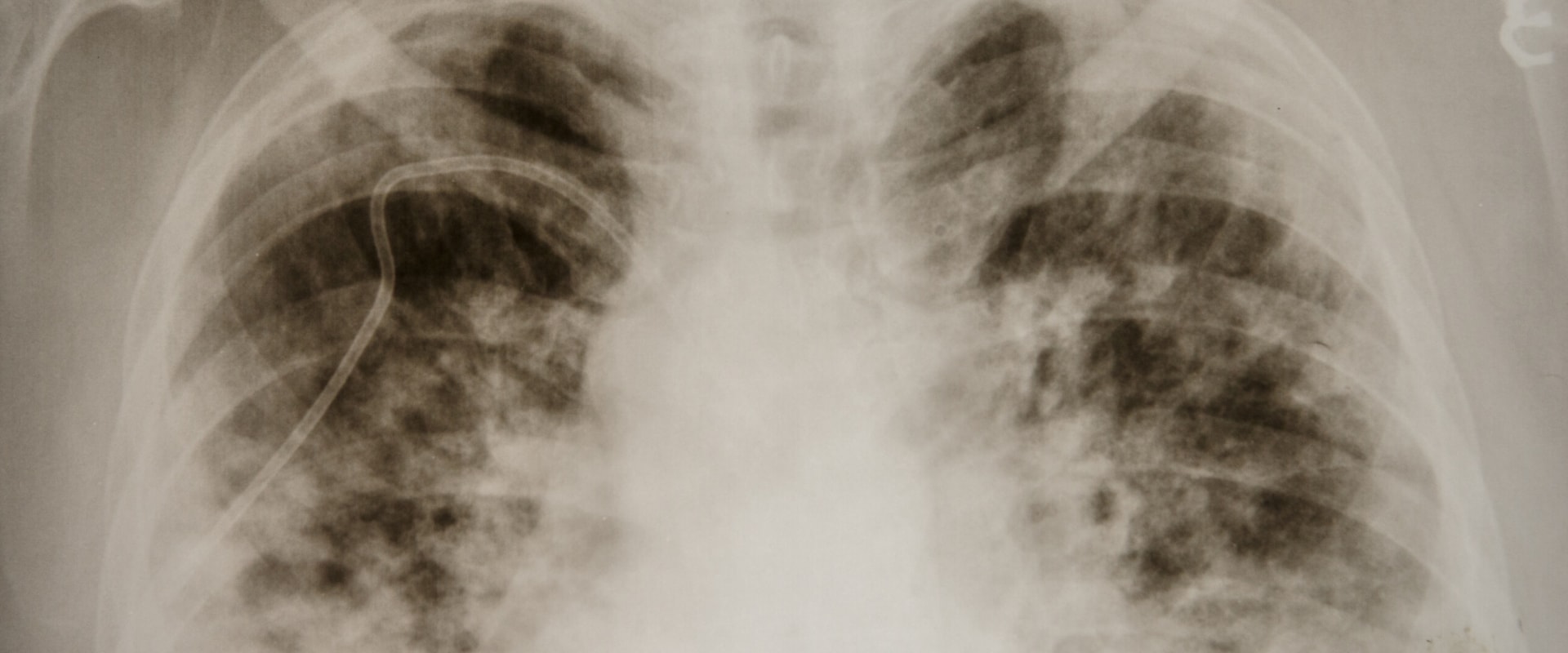 The Risks of Delta 8 on Lung Health