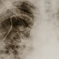 The Risks of Delta 8 on Lung Health